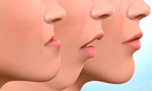 Cirug�a ortogn�tica | Maxilofacial Zaragoza | Dra. M�nica Lafont
