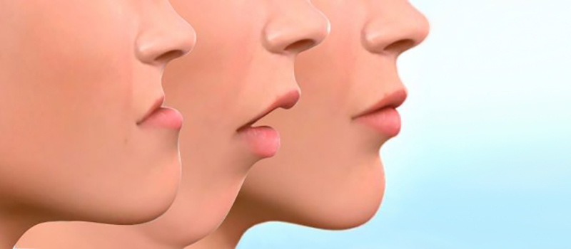Cirug�a ortogn�tica | Maxilofacial Zaragoza | Dra. M�nica Lafont