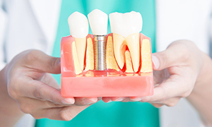 Implantolog�a | Maxilofacial Zaragoza | Dra. M�nica Lafont