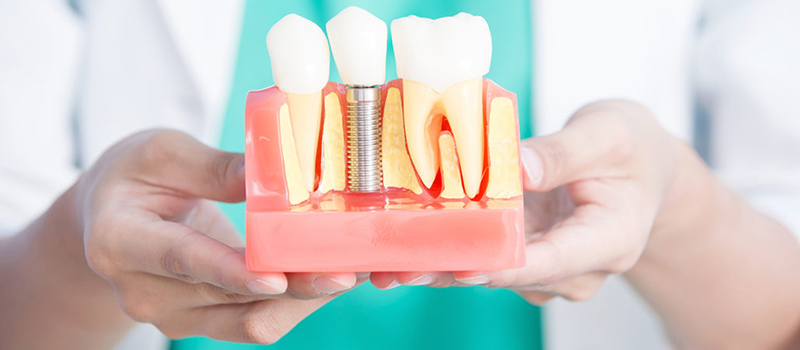 Implantolog�a | Maxilofacial Zaragoza | Dra. M�nica Lafont